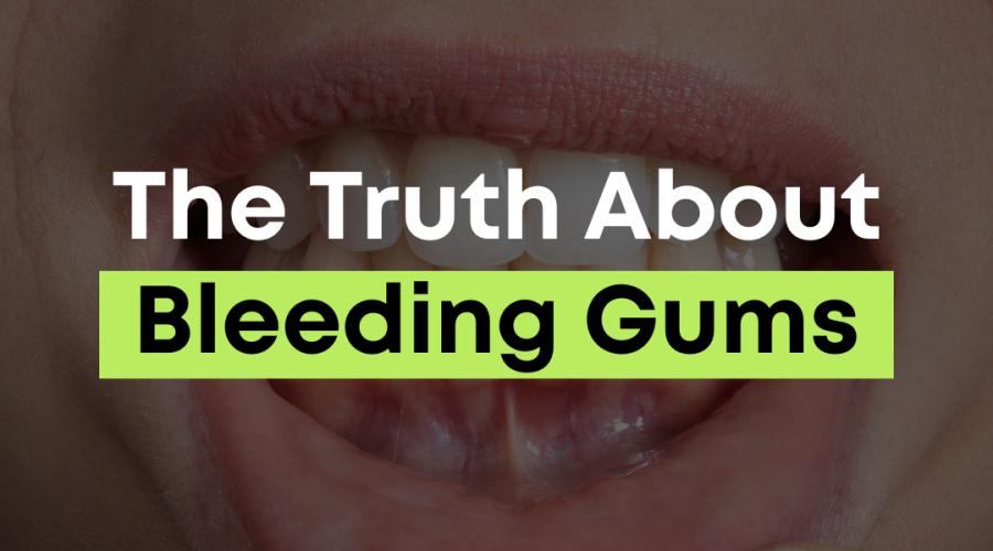 Close-up of bleeding gums representing the truth about bleeding gums and early signs of gum disease